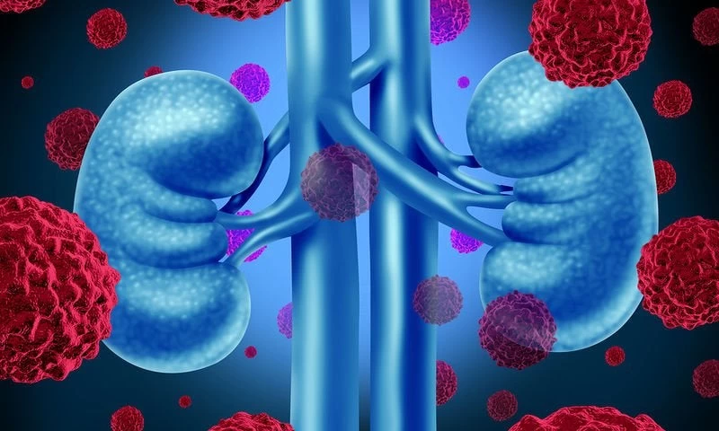 Νέα θεραπεία για τον καρκίνο στα νεφρά: Εφαρμόζεται για πρώτη φορά στην Ευρώπη